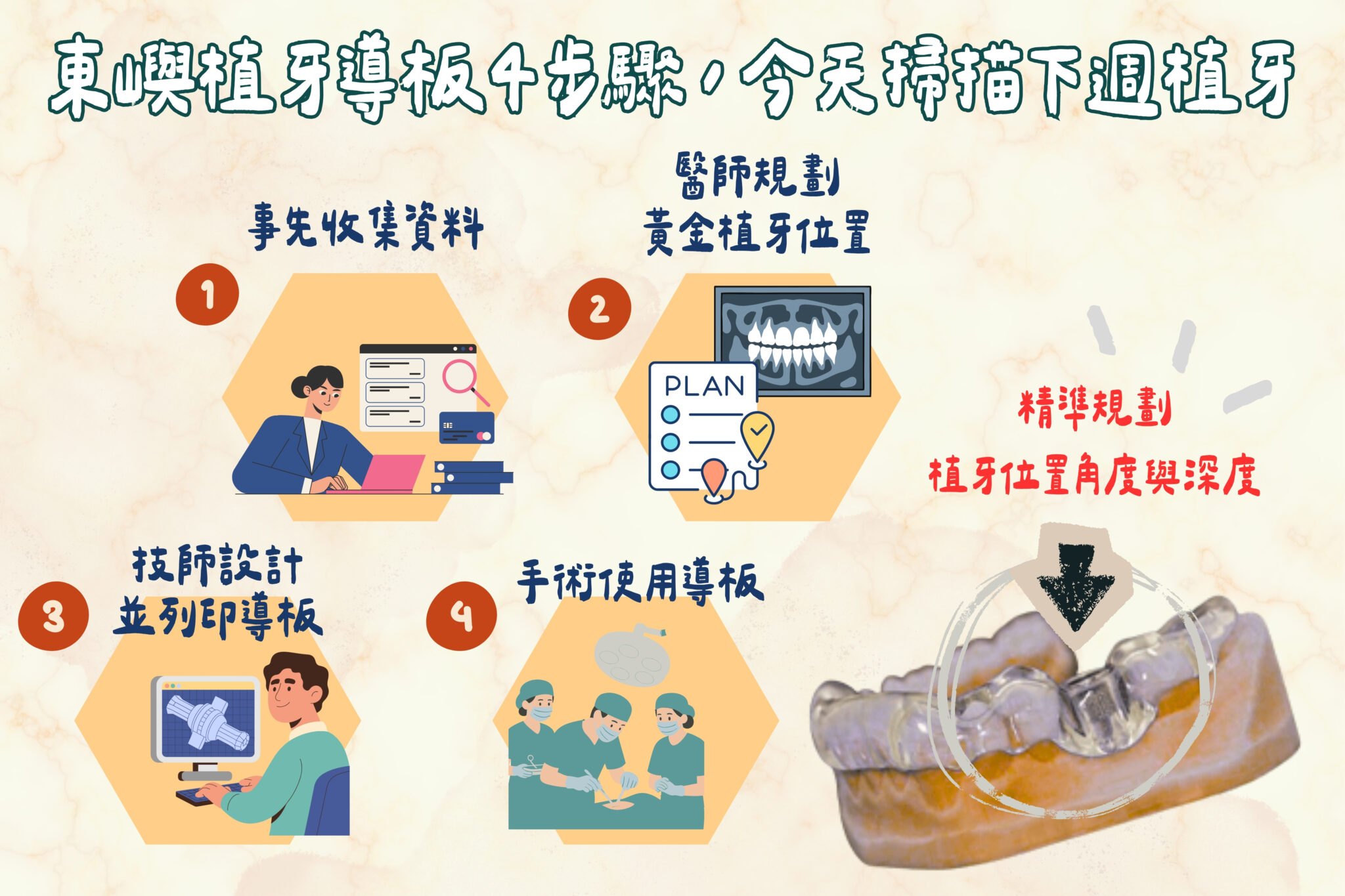東嶼植牙導板4步驟