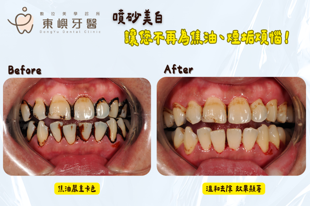 東嶼牙醫噴砂真實案例 讓您不再為焦油、煙垢煩惱！