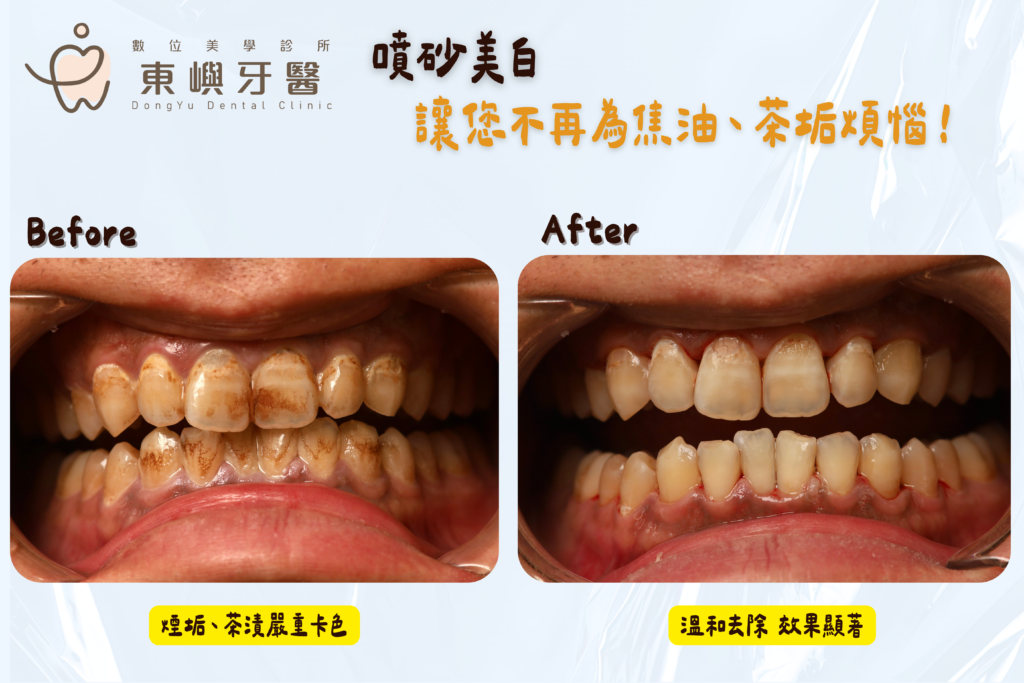 東嶼牙醫真實噴砂效果1