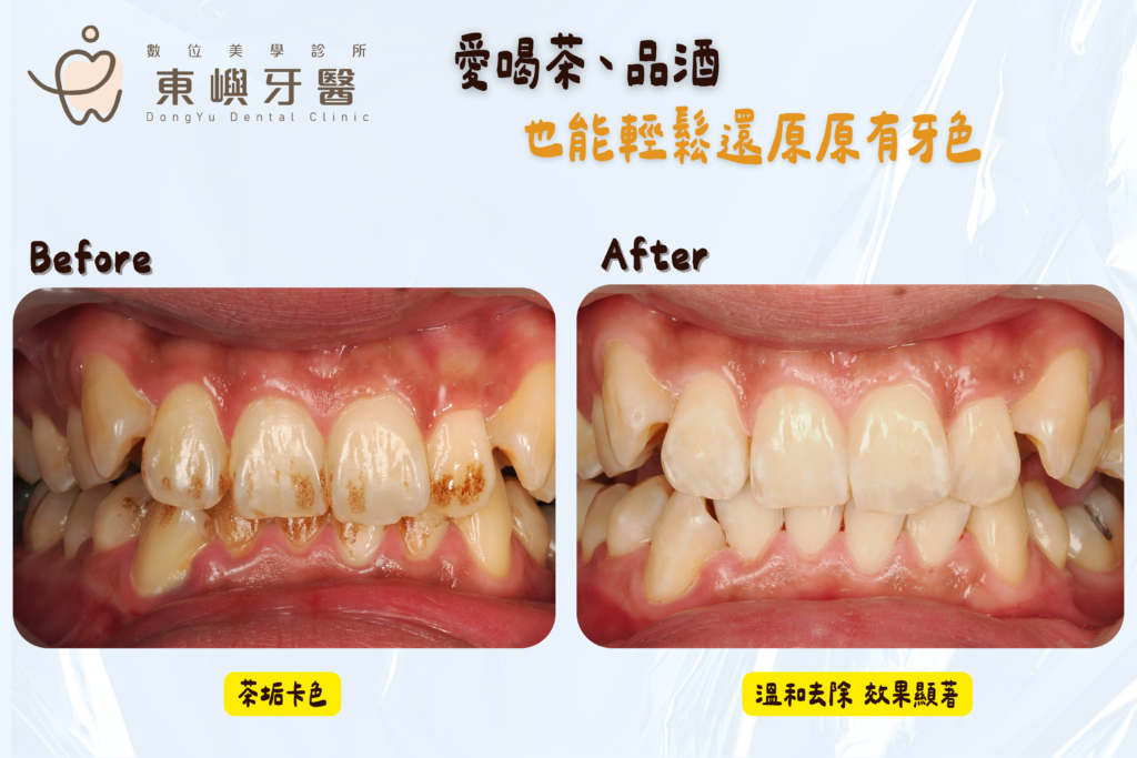 東嶼牙醫真實噴砂效果2