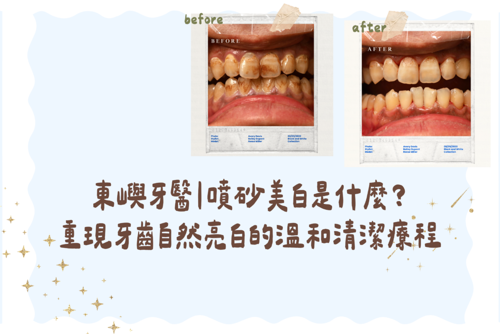 東嶼牙醫｜噴砂美白是什麼？ 重現牙齒自然亮白的溫和清潔療程 (1)