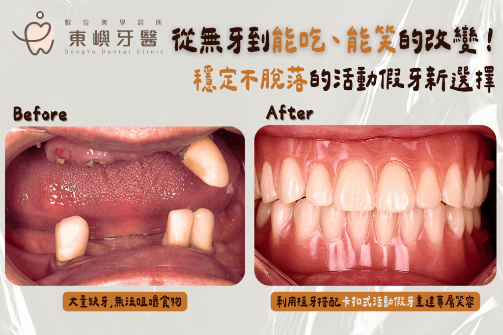 卡扣式活動假牙案例治療前後口內與外觀紀錄