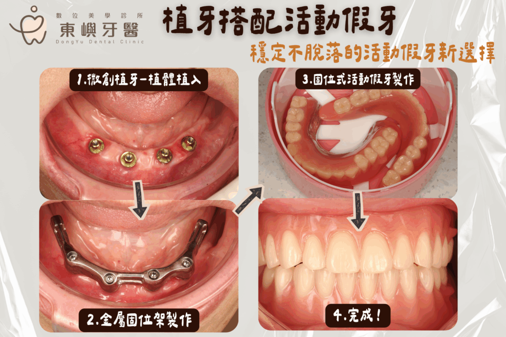 東嶼牙醫卡扣式活動假牙評估、植體與假牙製作流程紀錄