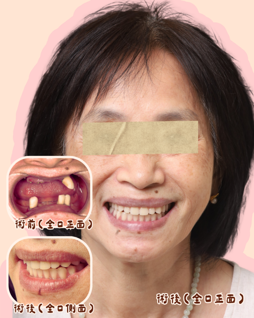 東嶼牙醫案例分享Before&after