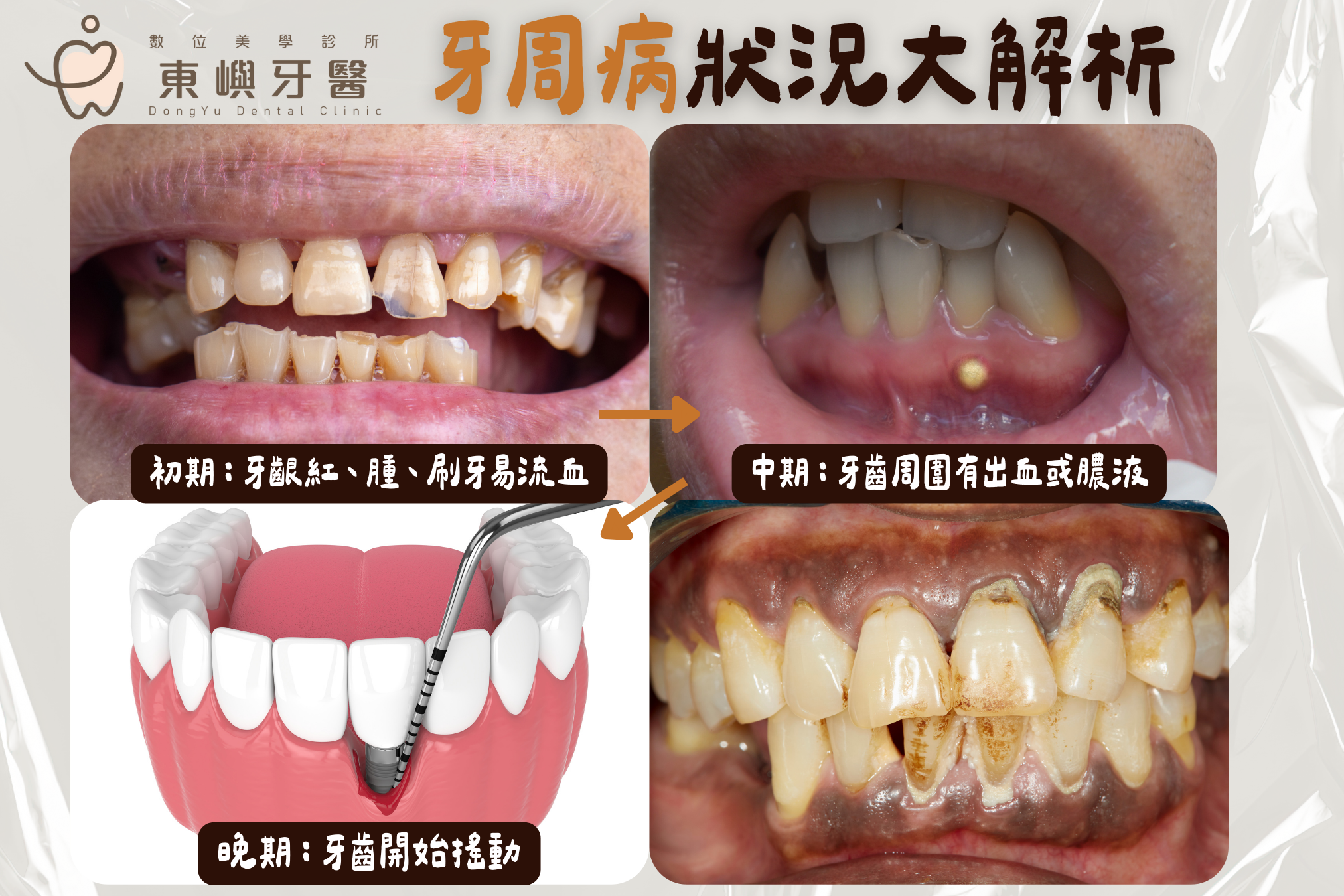 牙齦萎縮與牙周病｜可能增加植牙周圍炎風險