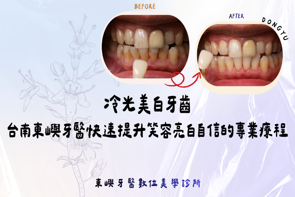 東嶼牙醫冷光美白網頁圖