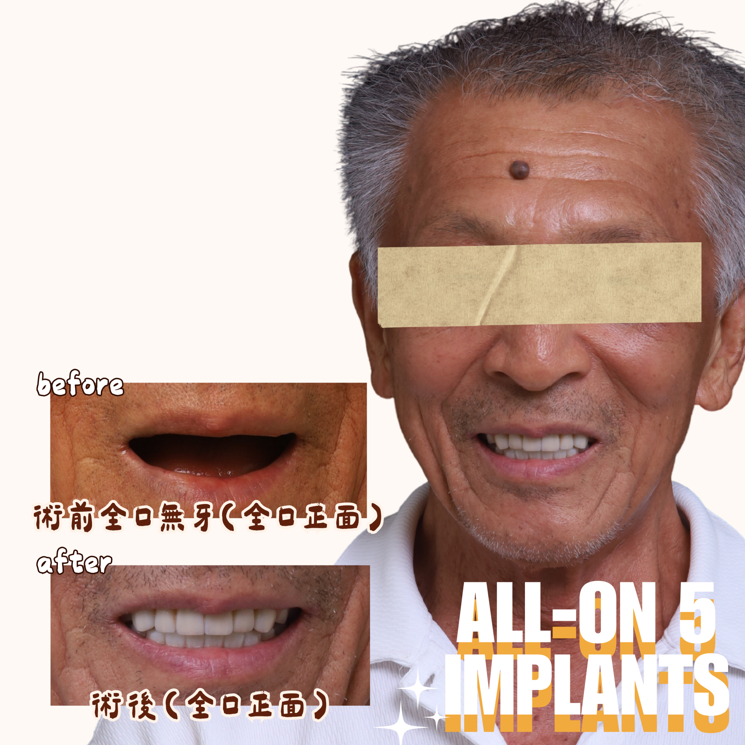 東嶼牙醫allon5案例2