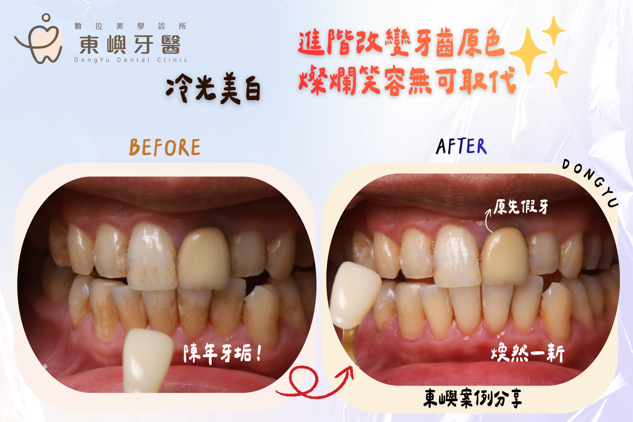 冷光美白天然牙色階改善案例一