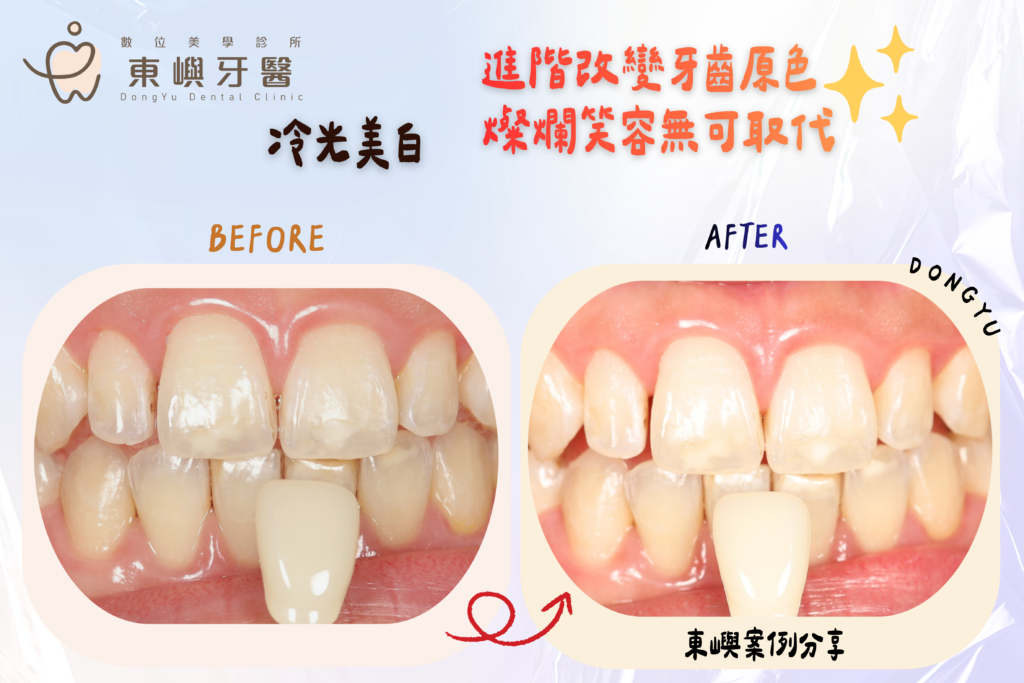 東嶼牙醫冷光案例2