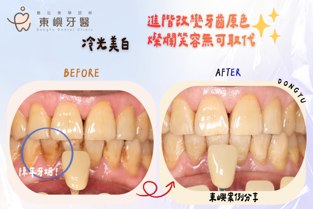 東嶼牙醫冷光案例3