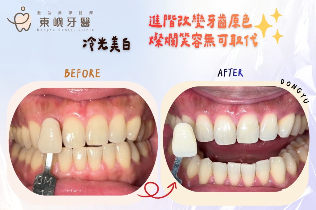東嶼牙醫冷光案例4