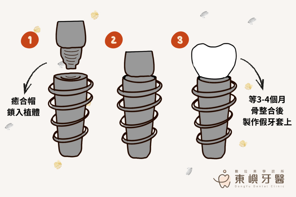 植牙流程介紹（癒合帽）東嶼牙醫