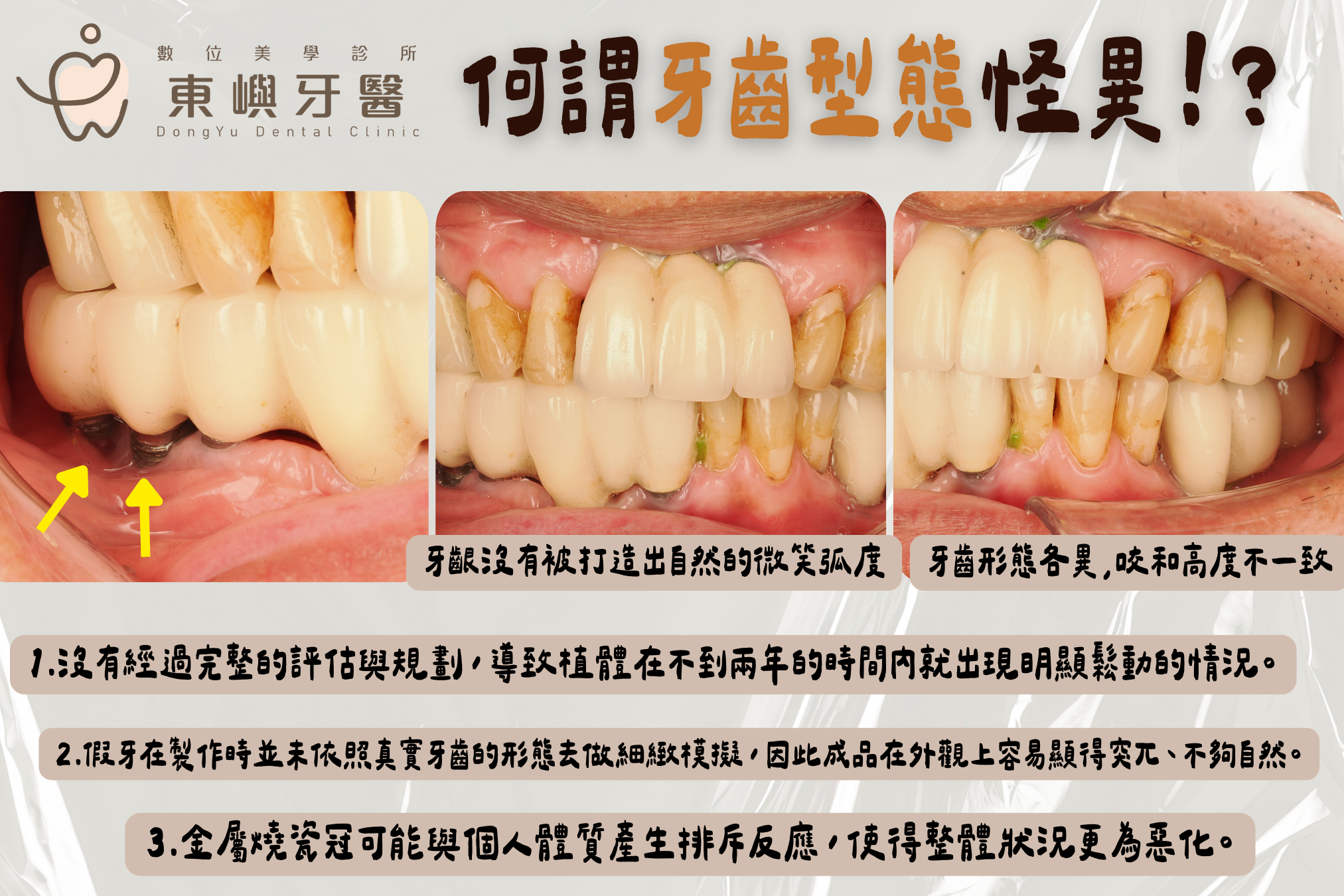 假牙形態不理想｜ 未完全符合牙齒自然形態