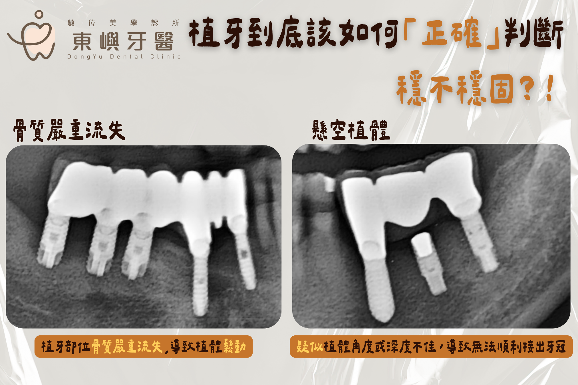 植牙骨頭嚴重萎縮｜ 主要失敗原因之一