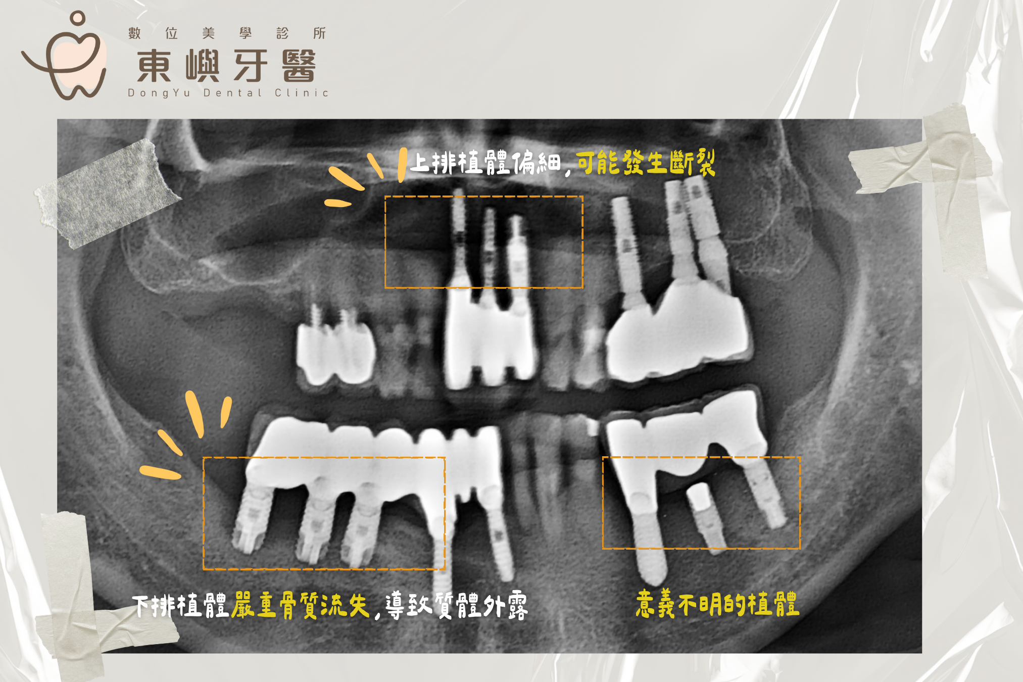 台南植牙失敗案例分析-植體周圍炎與骨頭萎縮檢查