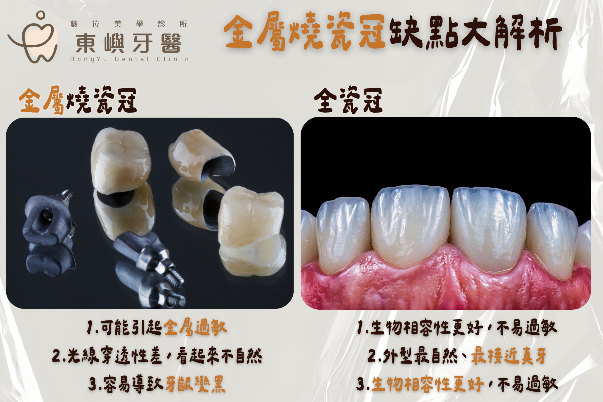 金屬燒瓷冠 ｜ 容易造成牙齦黑線與過敏