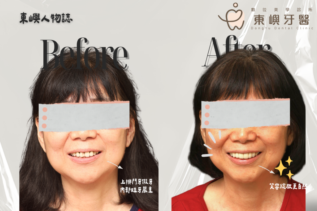 東嶼人物誌前牙上排美觀區before after 1