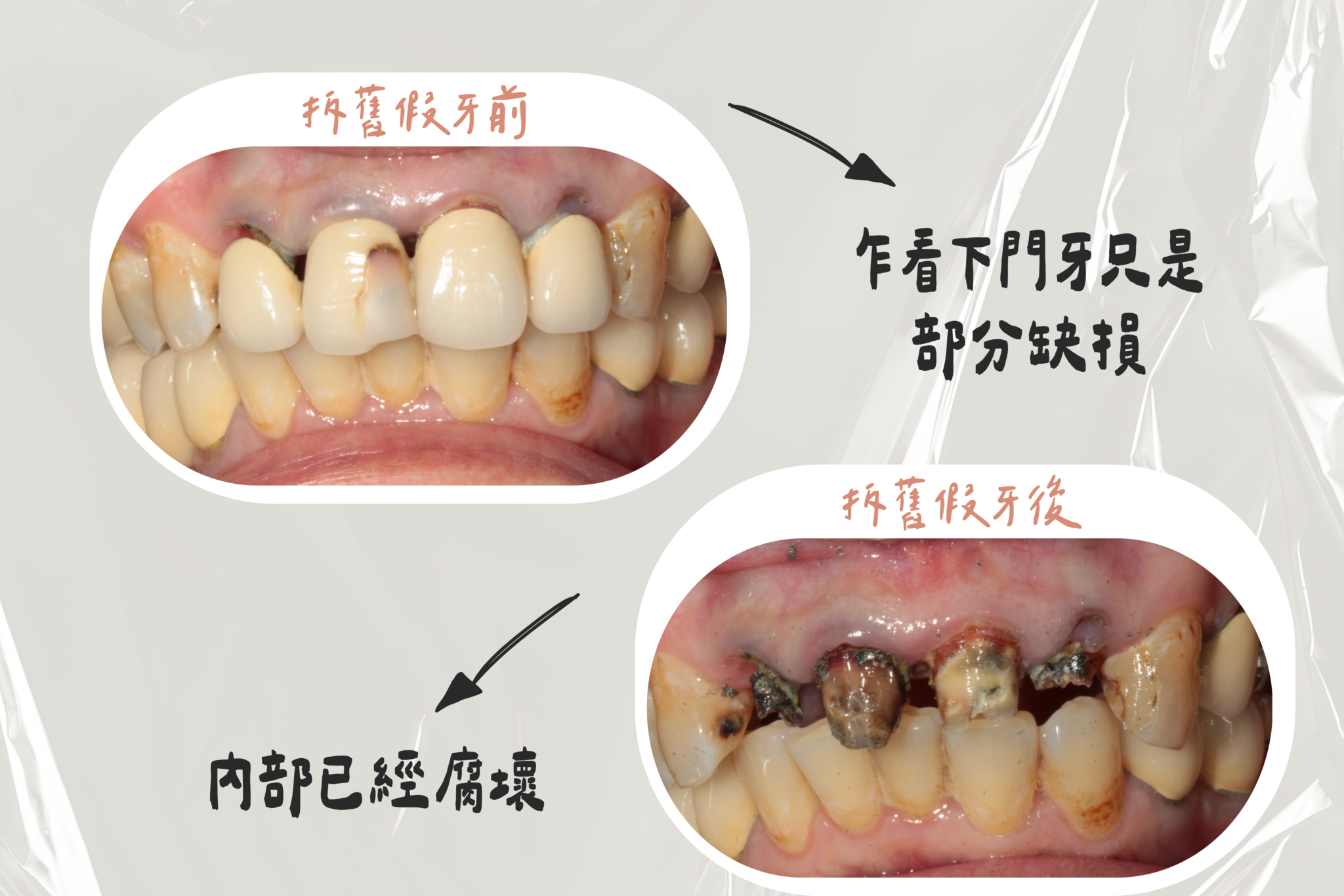 東嶼人物誌前牙上排美觀區before after 2