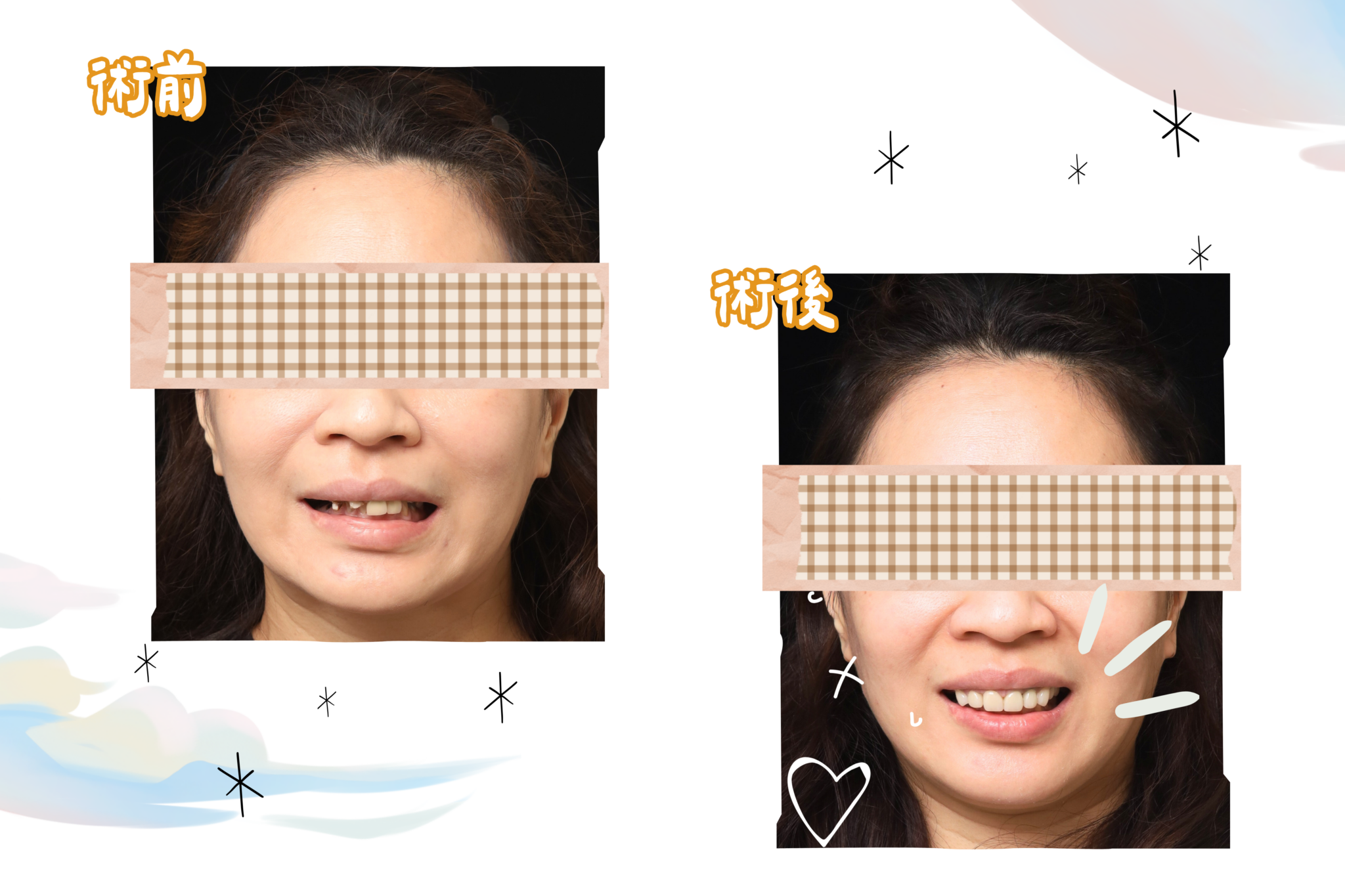 害怕看牙到重建笑容東嶼口患者前後比對照
