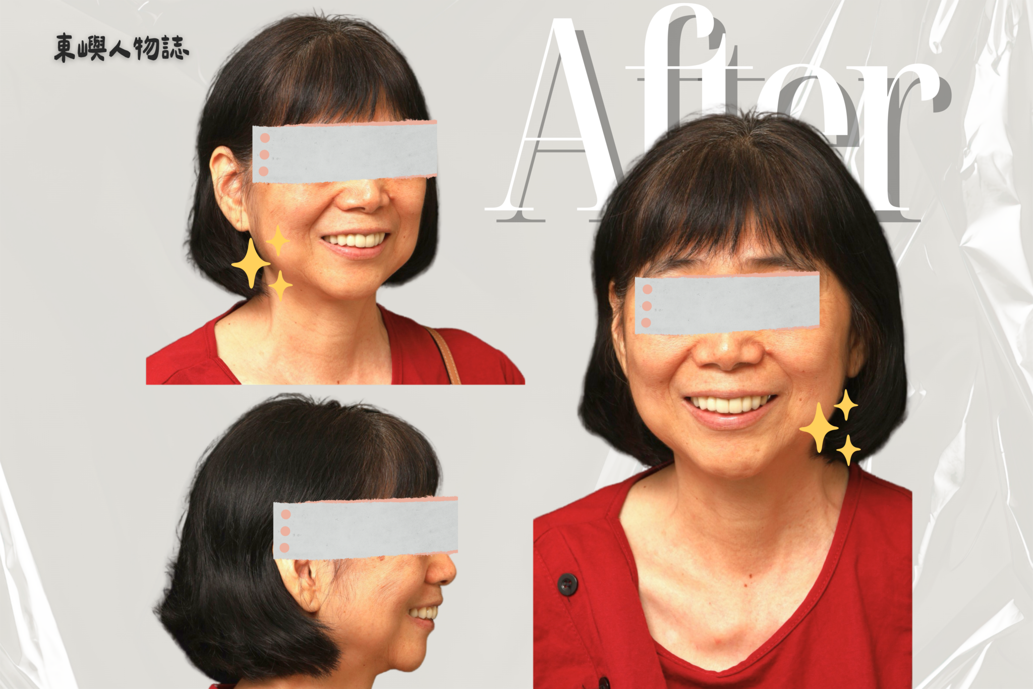 東嶼人物誌前牙上排美觀區before after 3