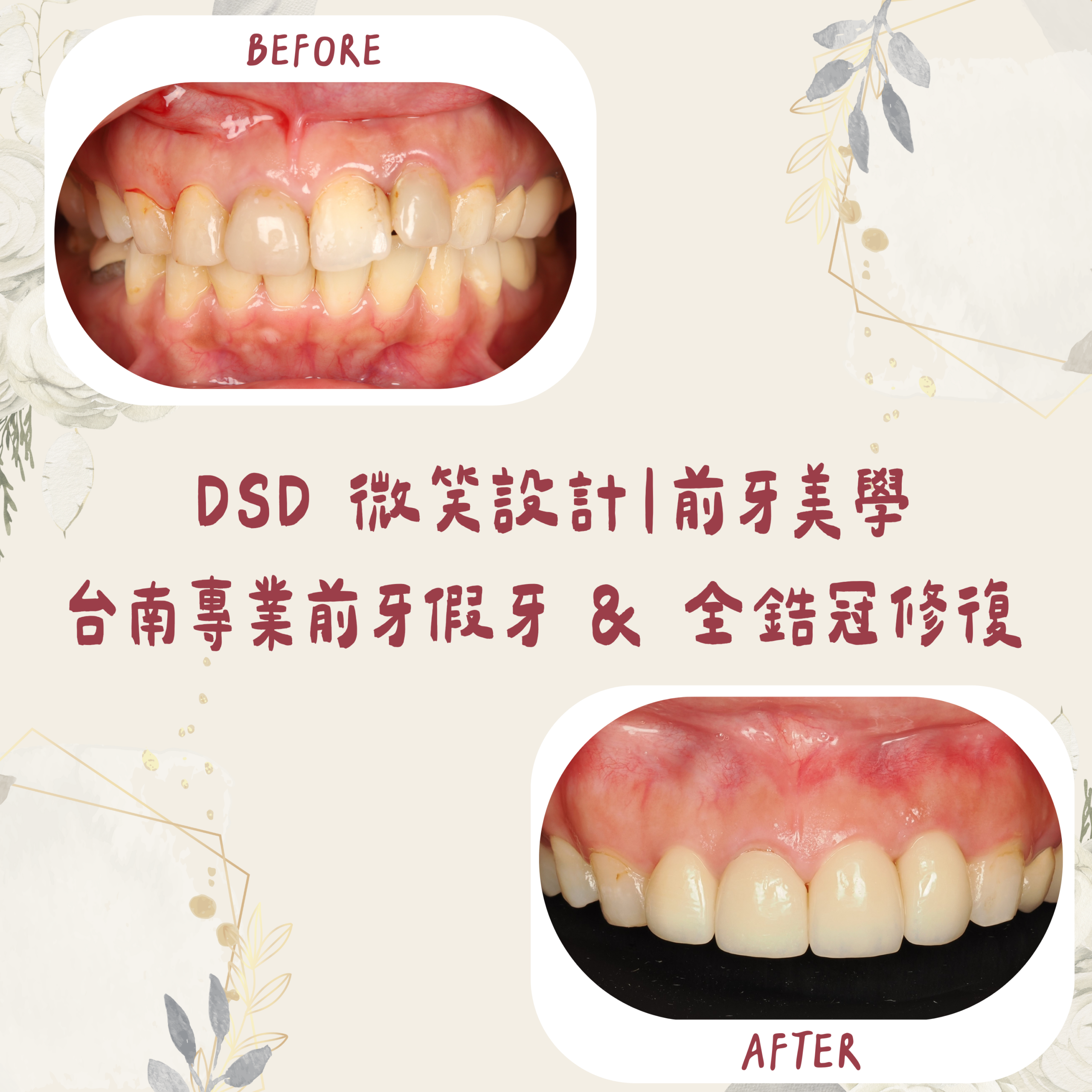 DSD 微笑設計｜前牙美學 台南專業前牙假牙 & 全鋯冠修復（假牙入口） (1)