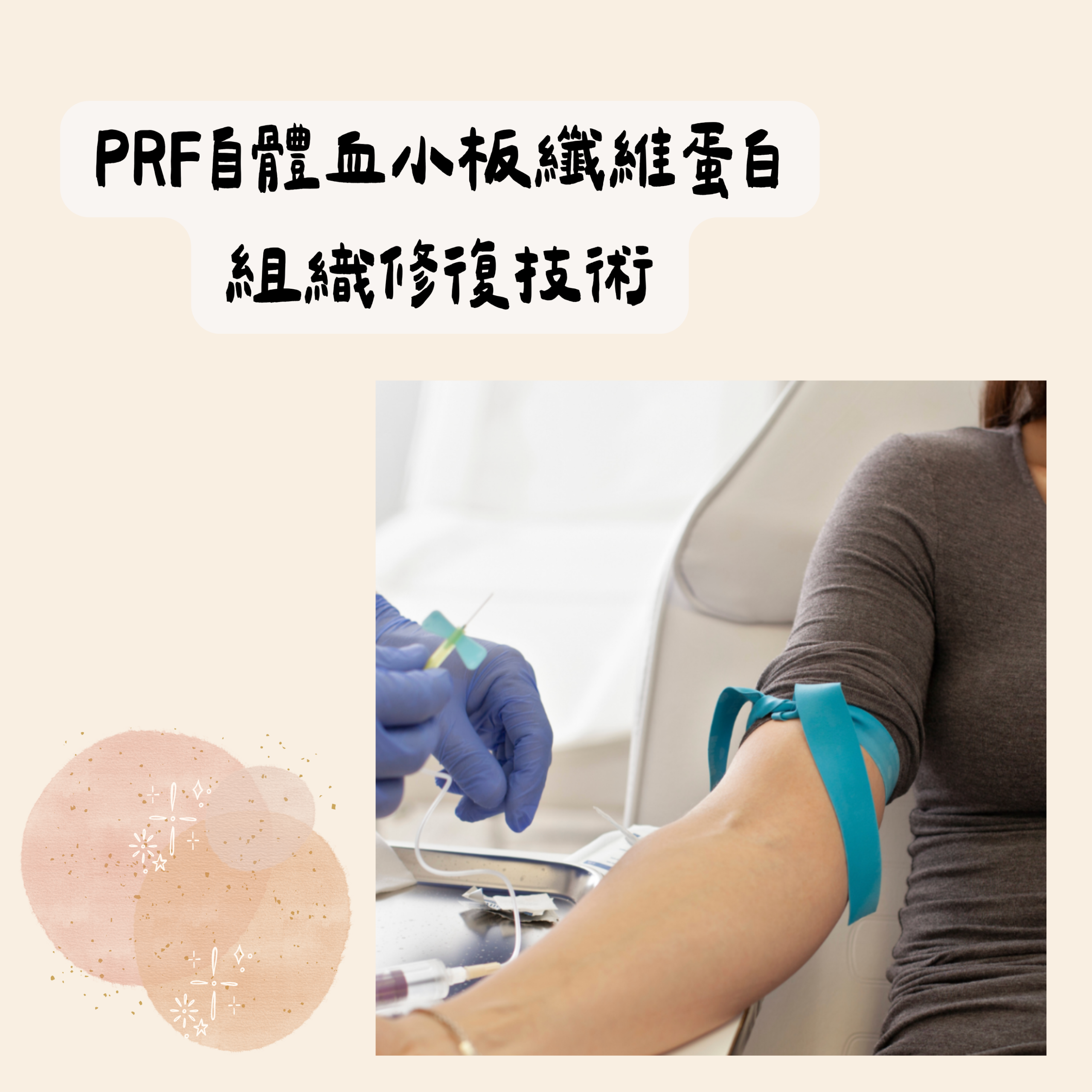 PRF自體血小板纖維蛋白組織修復技術