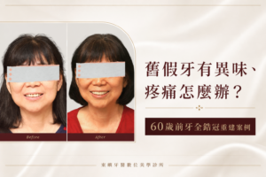 60歲患者前牙全鋯冠重建案例封面｜東嶼牙醫數位美學診所