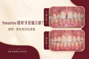 Smartee 隱形牙套療程、費用與評估封面｜東嶼牙醫數位美學診所