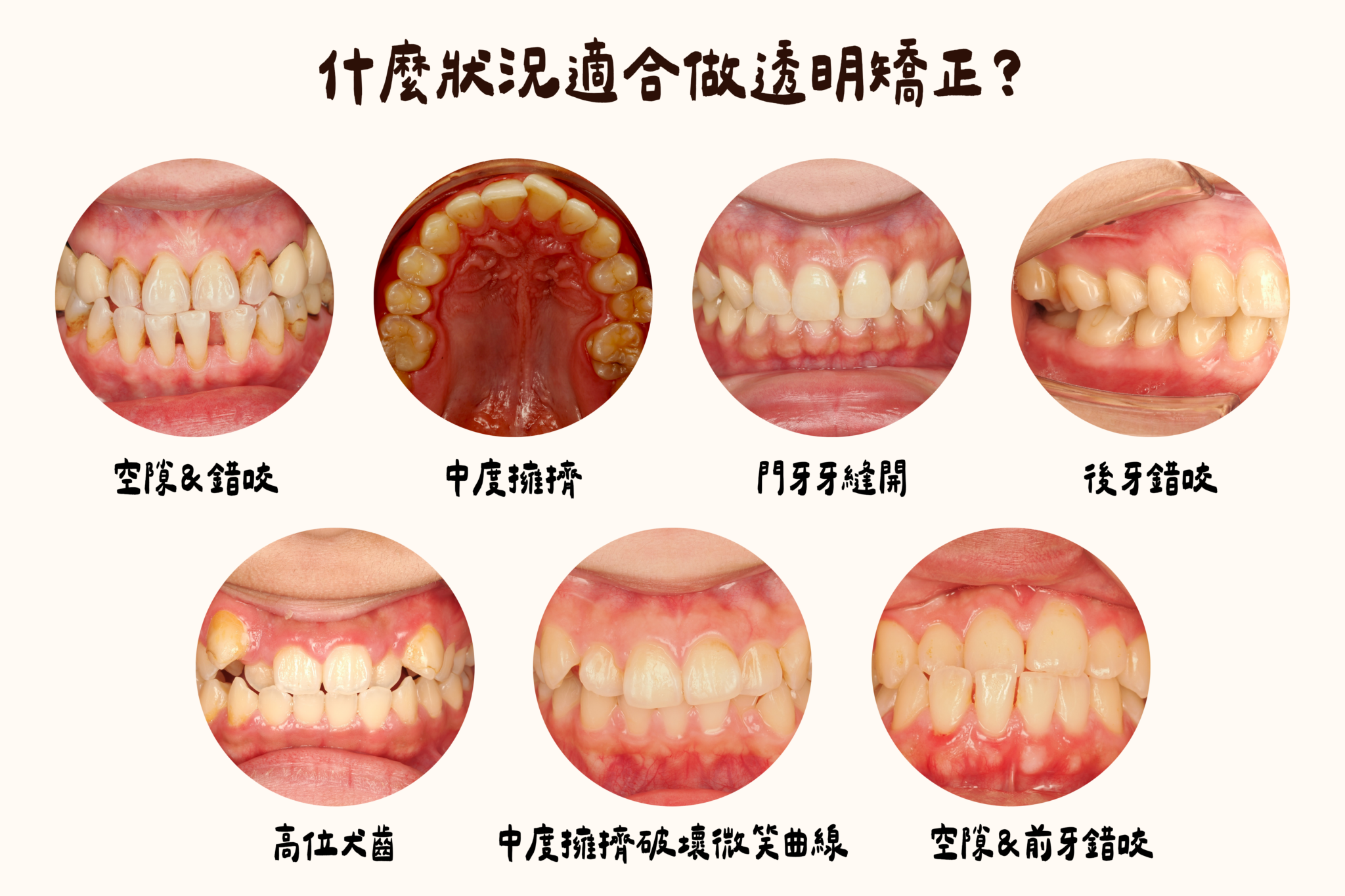 什麼情況適合隱適美矯正x台南東嶼牙醫