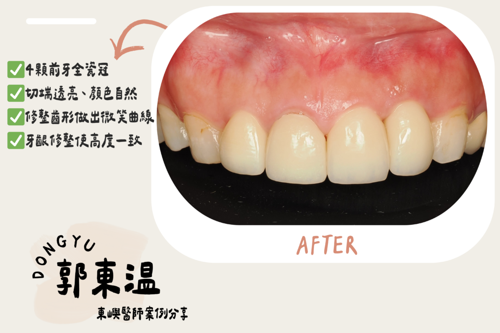 台南東嶼牙醫＿後牙美學_after