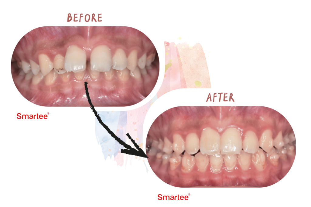 東嶼smartee矯正案例2暴牙改善