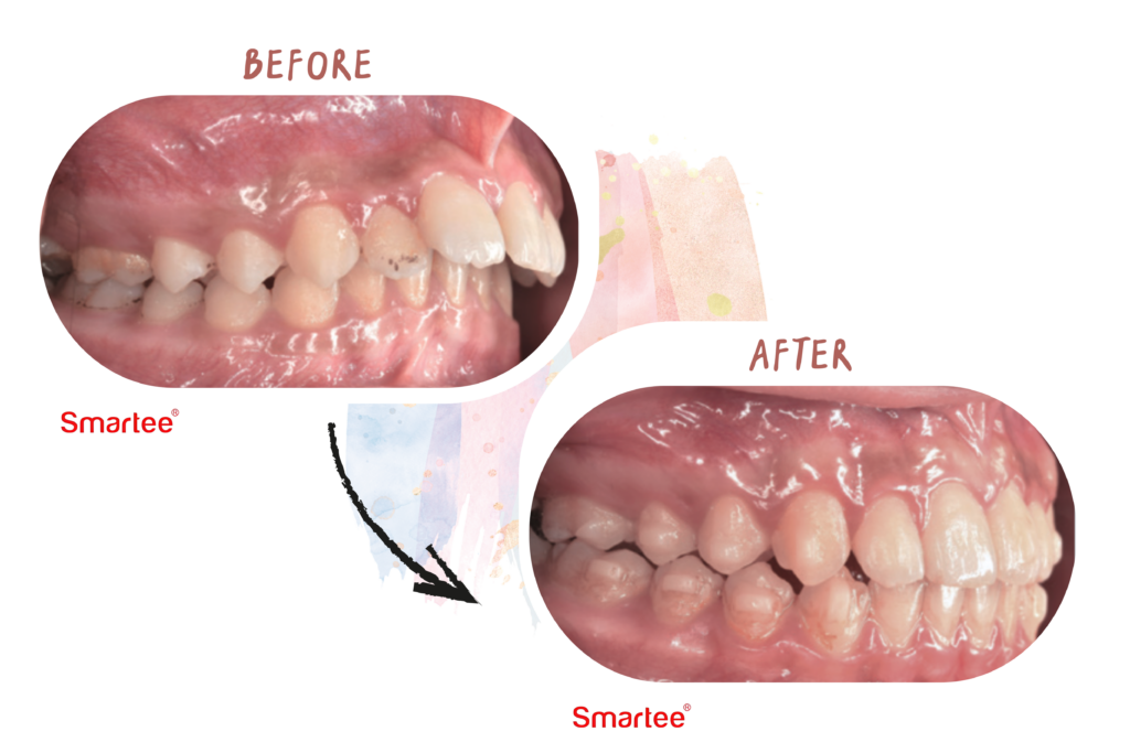 東嶼smartee矯正案例2-2暴牙改善