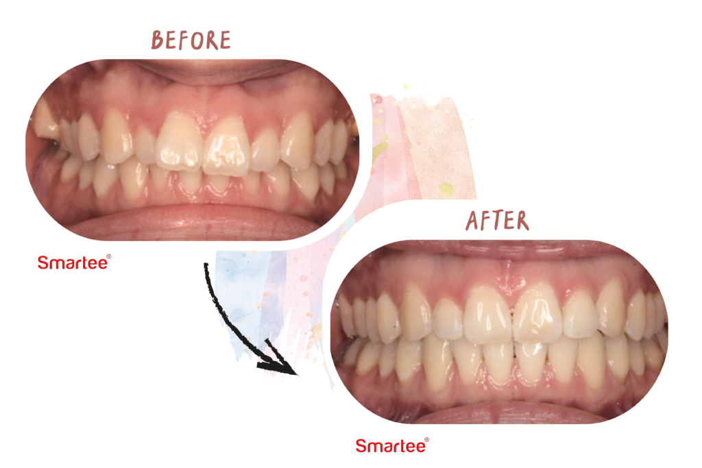 東嶼smarteer矯正案例3