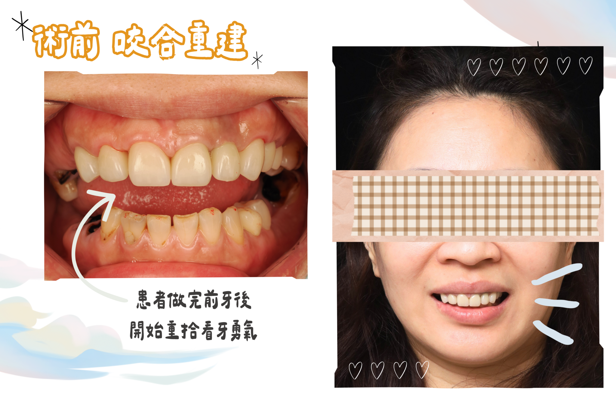 東嶼咬合重建after