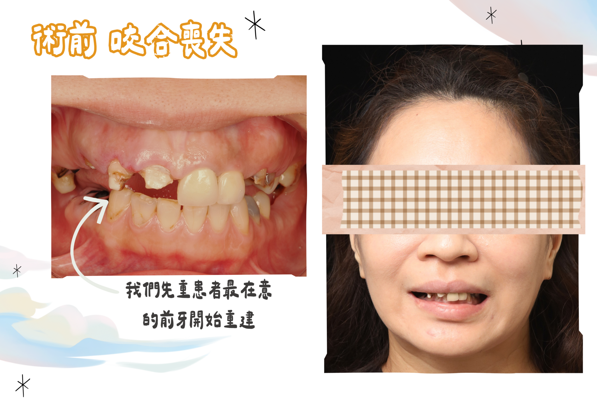 東嶼咬合重建before