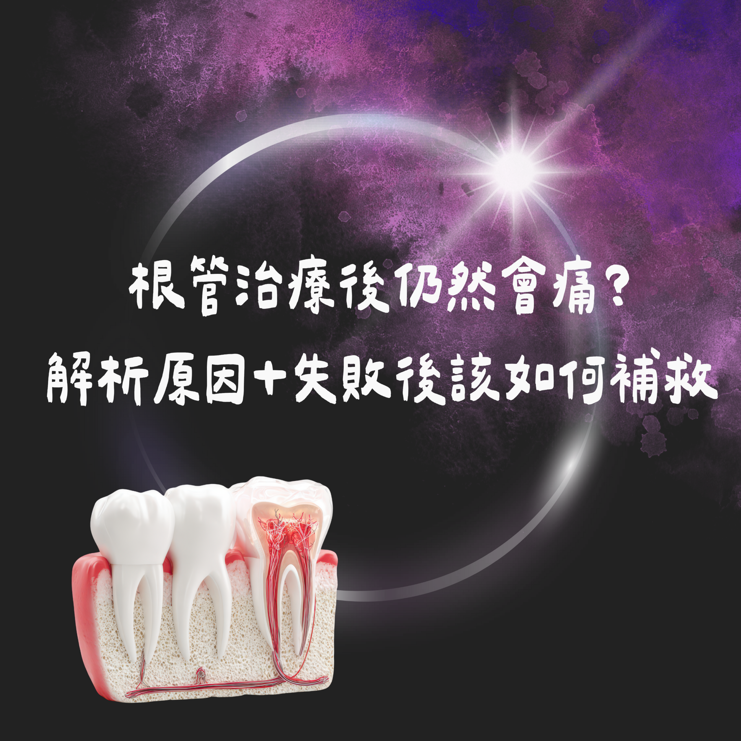 根管治療後仍然會痛？ 解析原因＋失敗後該如何補救