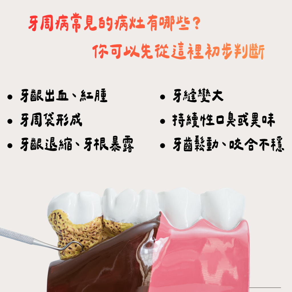 東嶼牙醫x牙周病如和判斷