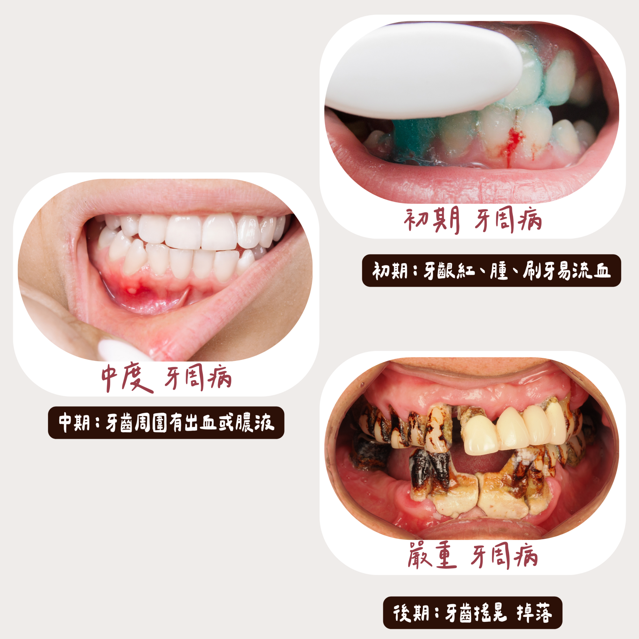 牙周病三階段x東嶼牙醫