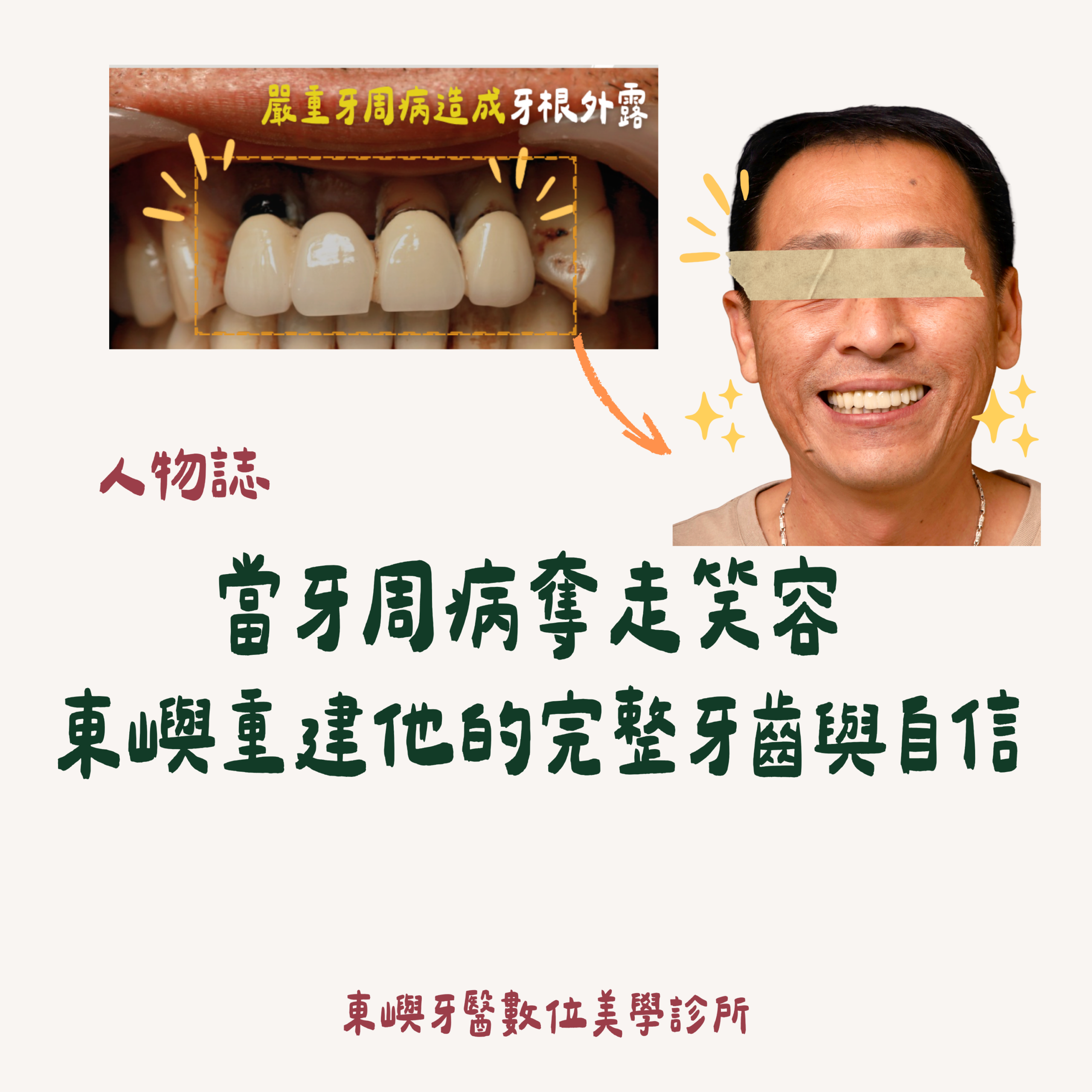 當牙周病奪走笑容東嶼重建他的完整牙齒與自信縮圖