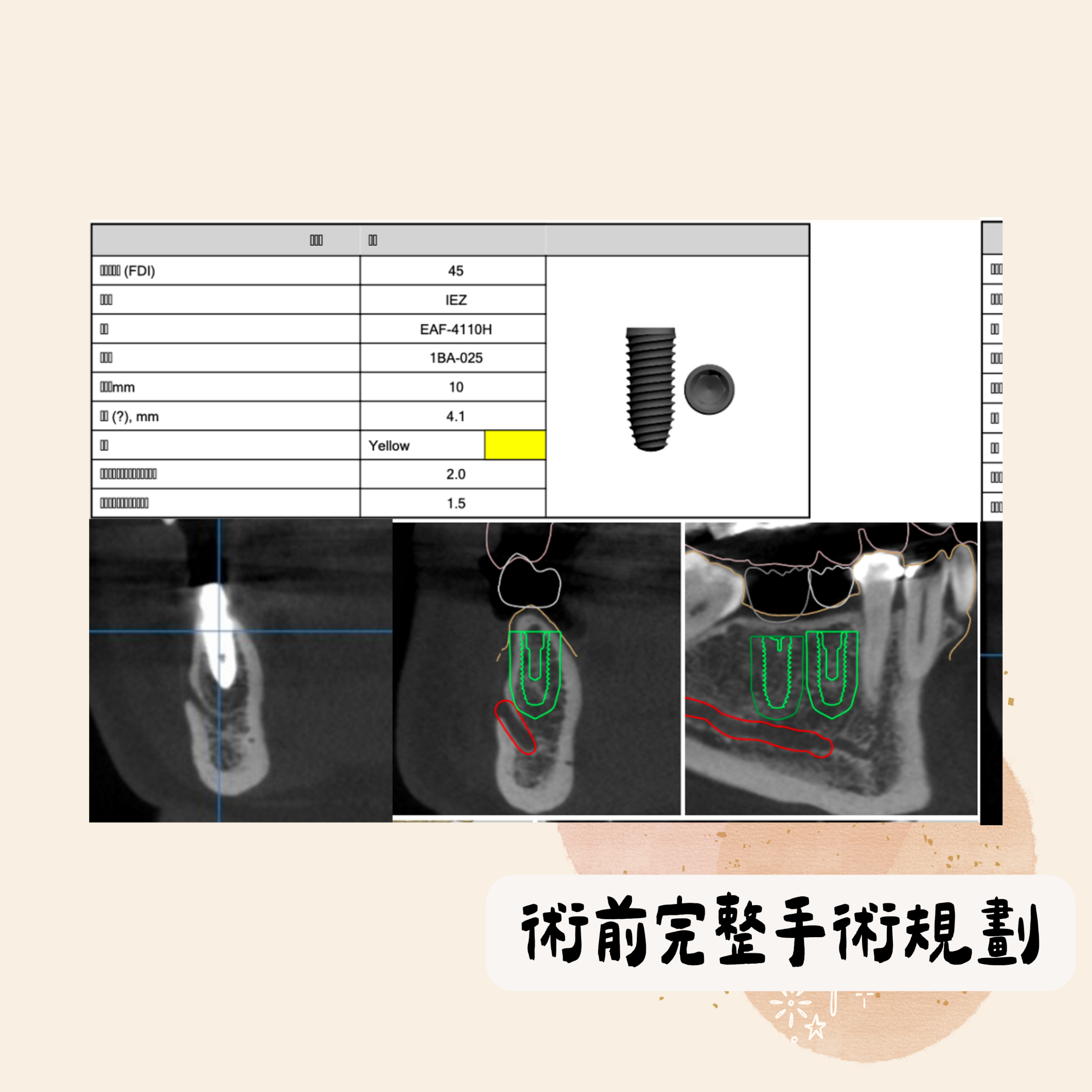 術前完整手術規劃