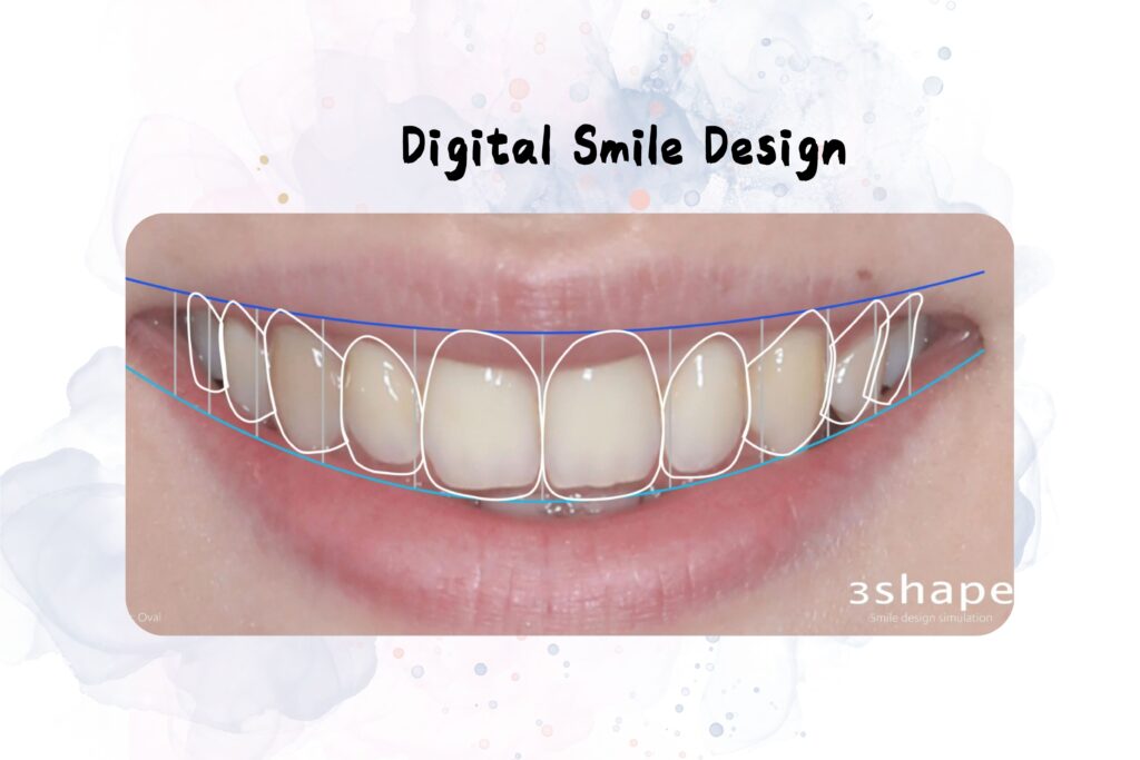 Digital Smile Design