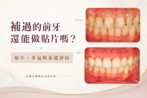 補過的前牙貼片、牙冠與重建評估案例封面｜東嶼牙醫數位美學診所
