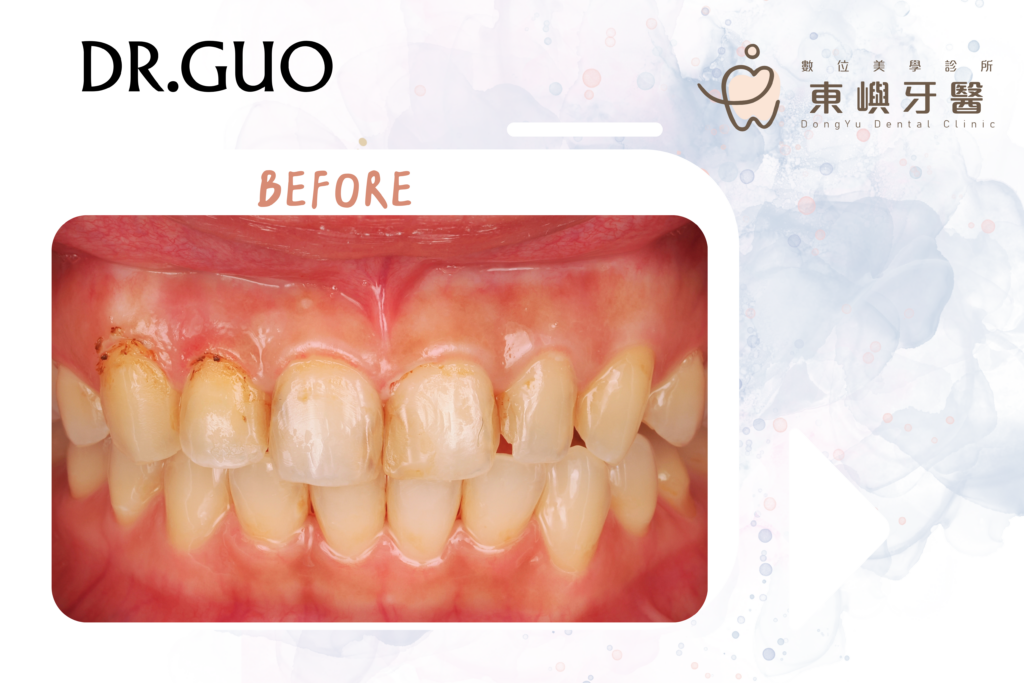 前牙假牙before