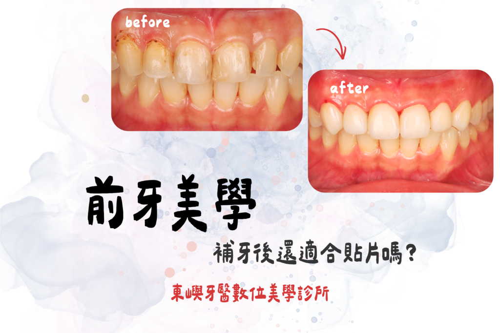 前牙美學-補牙後還適合貼片嗎？東嶼牙醫 (1)
