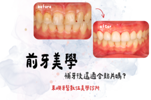 前牙美學-補牙後還適合貼片嗎？東嶼牙醫 (1)
