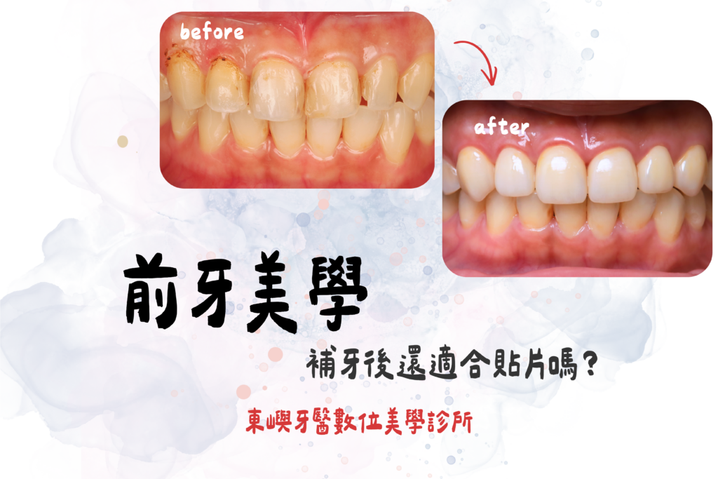 前牙美學-補牙後還適合貼片嗎？