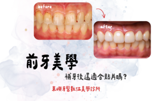 前牙美學-補牙後還適合貼片嗎？