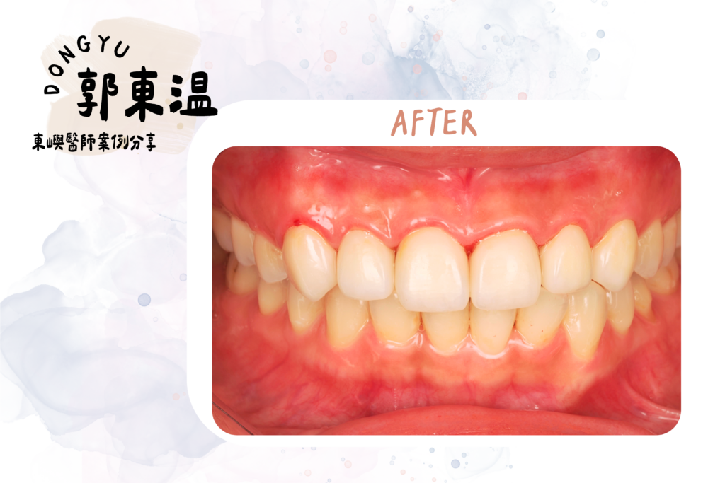 前牙美學-補牙後還適合貼片嗎？ case完成照