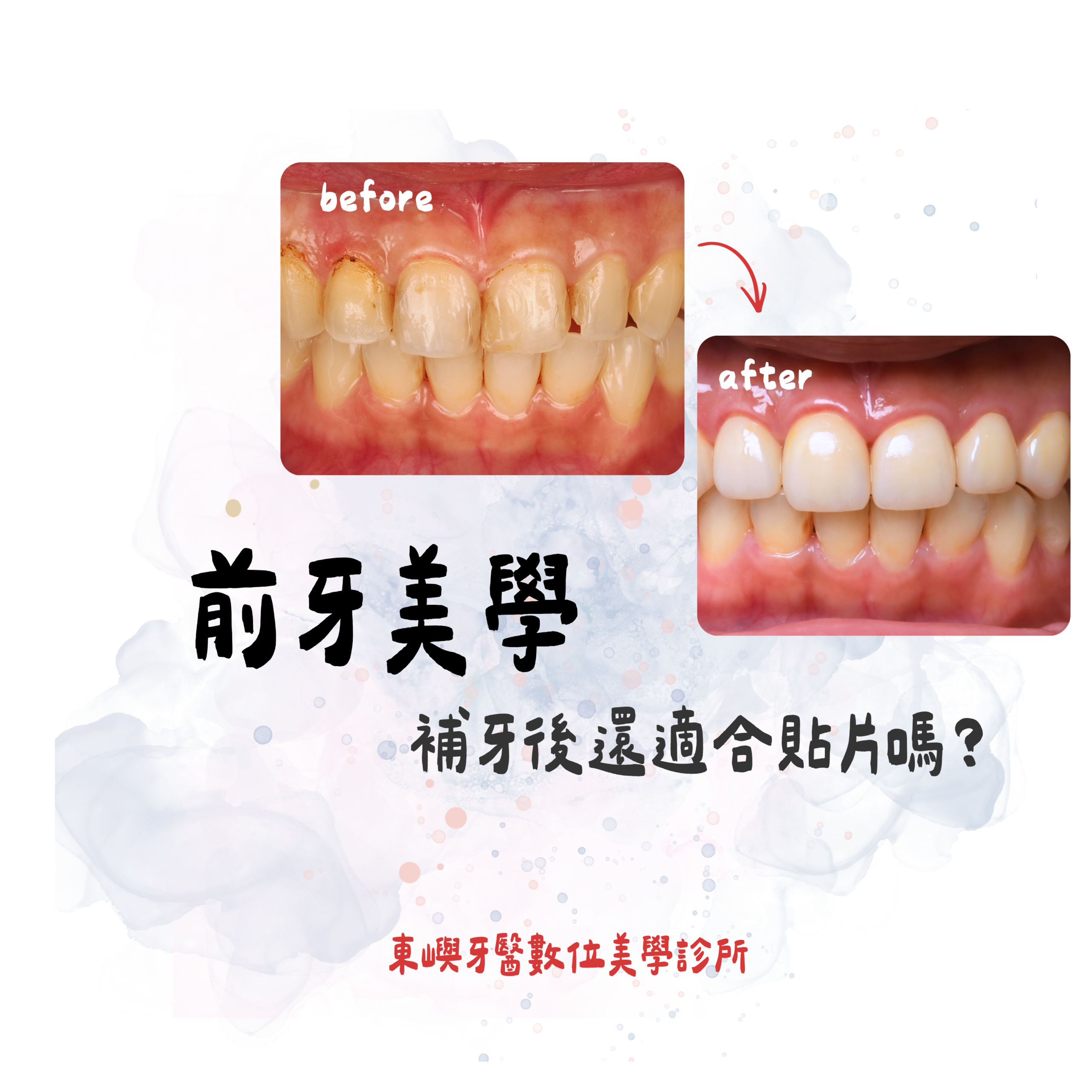 補牙後還適合貼片嗎？