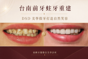 台南前牙蛀牙重建與 DSD 美學假牙案例封面｜東嶼牙醫數位美學診所